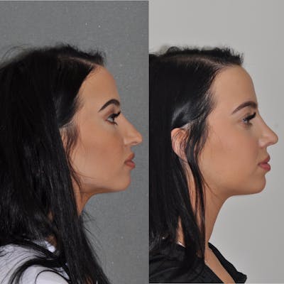 Revision Rhinoplasty Before & After Gallery - Patient 31709171 - Image 2