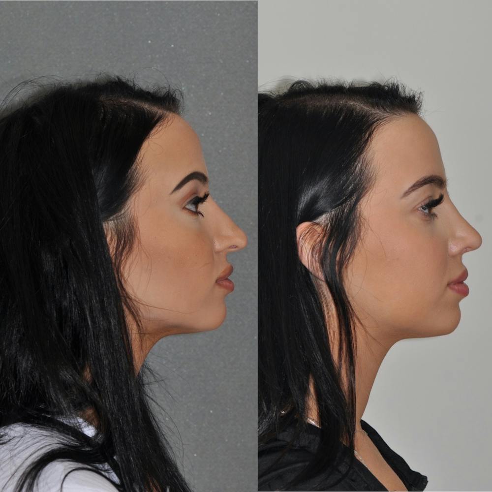Revision Rhinoplasty Before & After Gallery - Patient 31709171 - Image 2