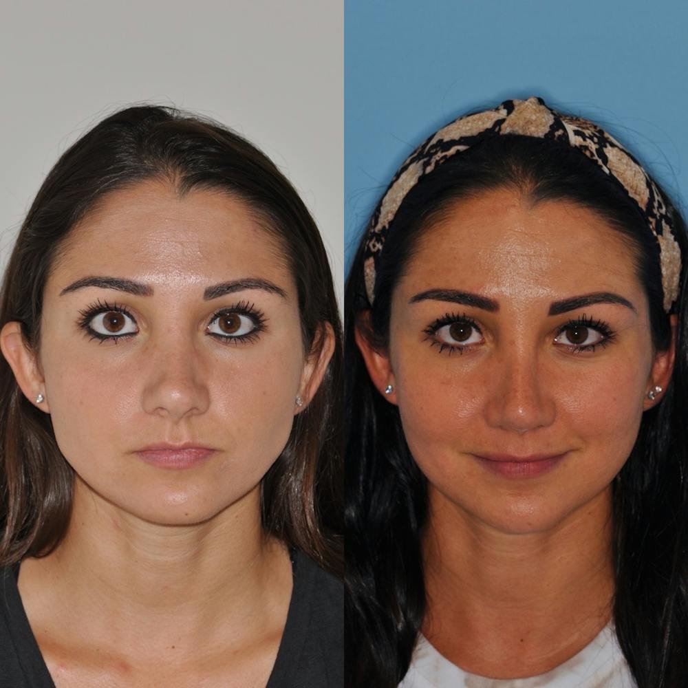 Revision Rhinoplasty Before & After Gallery - Patient 31709170 - Image 3