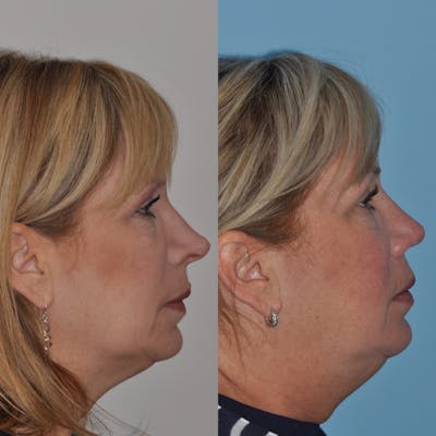 Revision Rhinoplasty Before & After Gallery - Patient 30624186 - Image 2