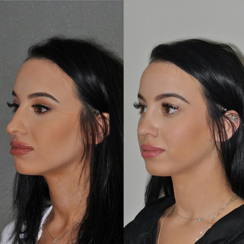 Revision Rhinoplasty Before & After Gallery - Patient 31709171 - Image 3