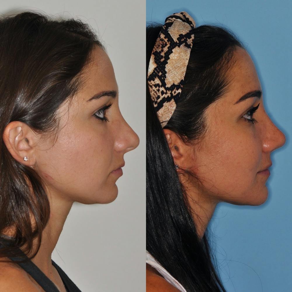 Revision Rhinoplasty Before & After Gallery - Patient 31709170 - Image 4