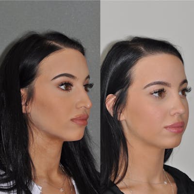 Revision Rhinoplasty Before & After Gallery - Patient 31709171 - Image 4