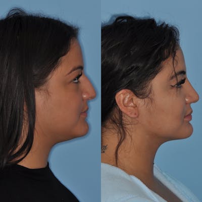 Neck Liposuction Before & After Gallery - Patient 31709174 - Image 1