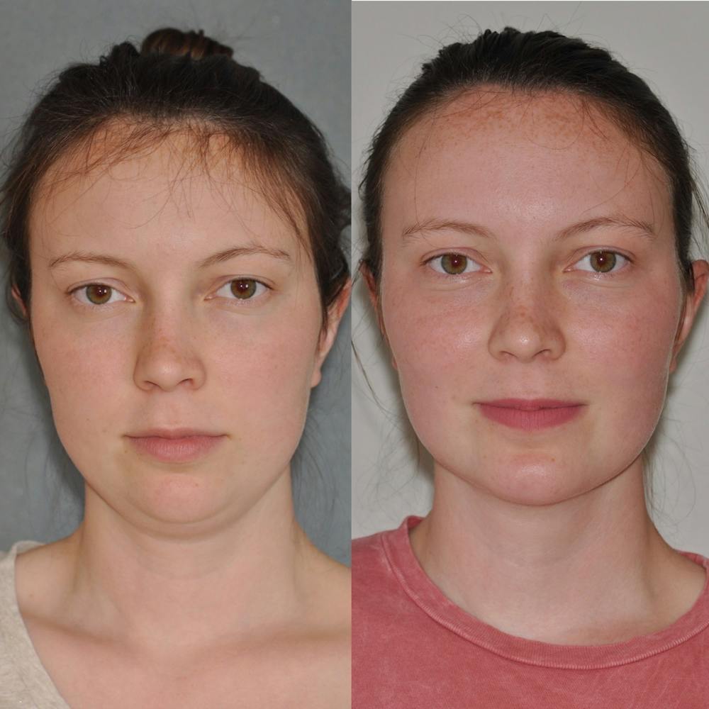 Neck Liposuction Before & After Gallery - Patient 31709172 - Image 4