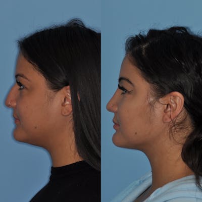 Neck Liposuction Before & After Gallery - Patient 31709174 - Image 4