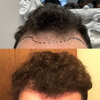 Hair Transplantation Before & After Gallery - Patient 31709193 - Image 1