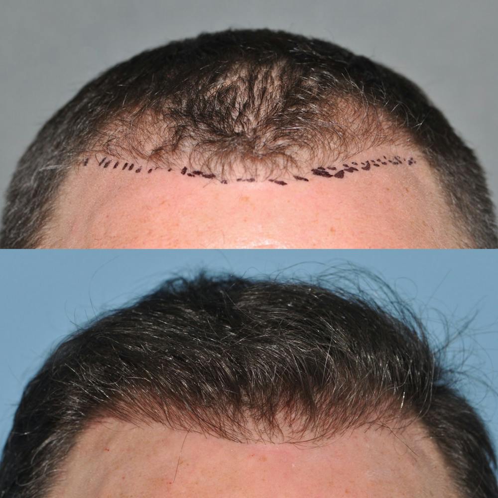 Hair Transplantation Before & After Gallery - Patient 31709194 - Image 2