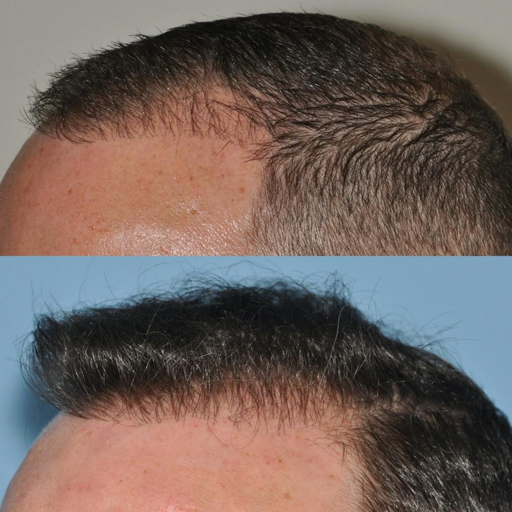 Hair Transplantation Before & After Gallery - Patient 31709194 - Image 3