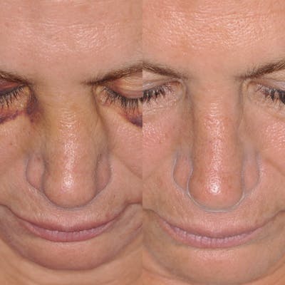 Facial Reconstruction Before & After Gallery - Patient 31709203 - Image 1