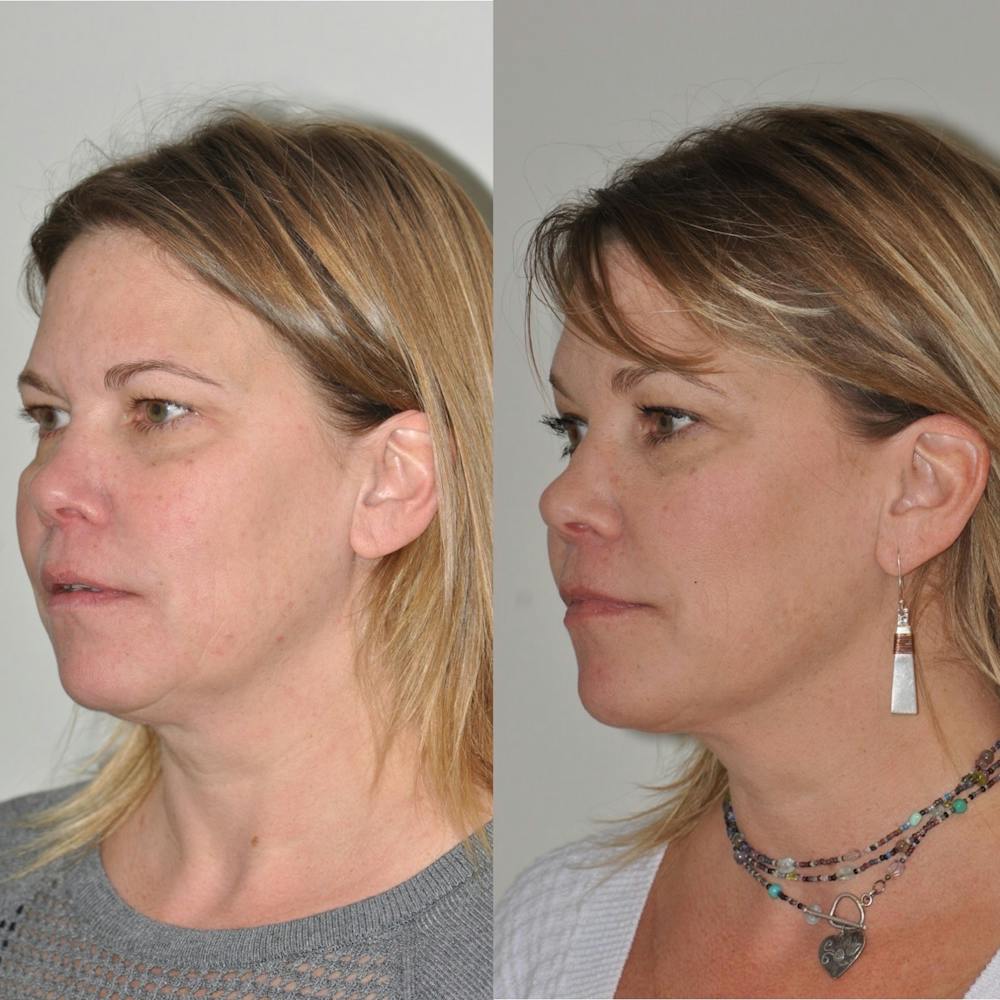 FaceTite & ThermiTight Before & After Gallery - Patient 31709213 - Image 1