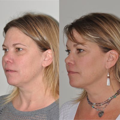 FaceTite & ThermiTight Before & After Gallery - Patient 31709213 - Image 1