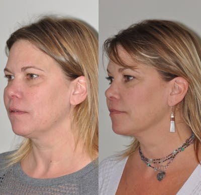FaceTite & ThermiTight Before & After Gallery - Patient 31709213 - Image 2