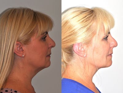 FaceTite & ThermiTight Before & After Gallery - Patient 31709214 - Image 2