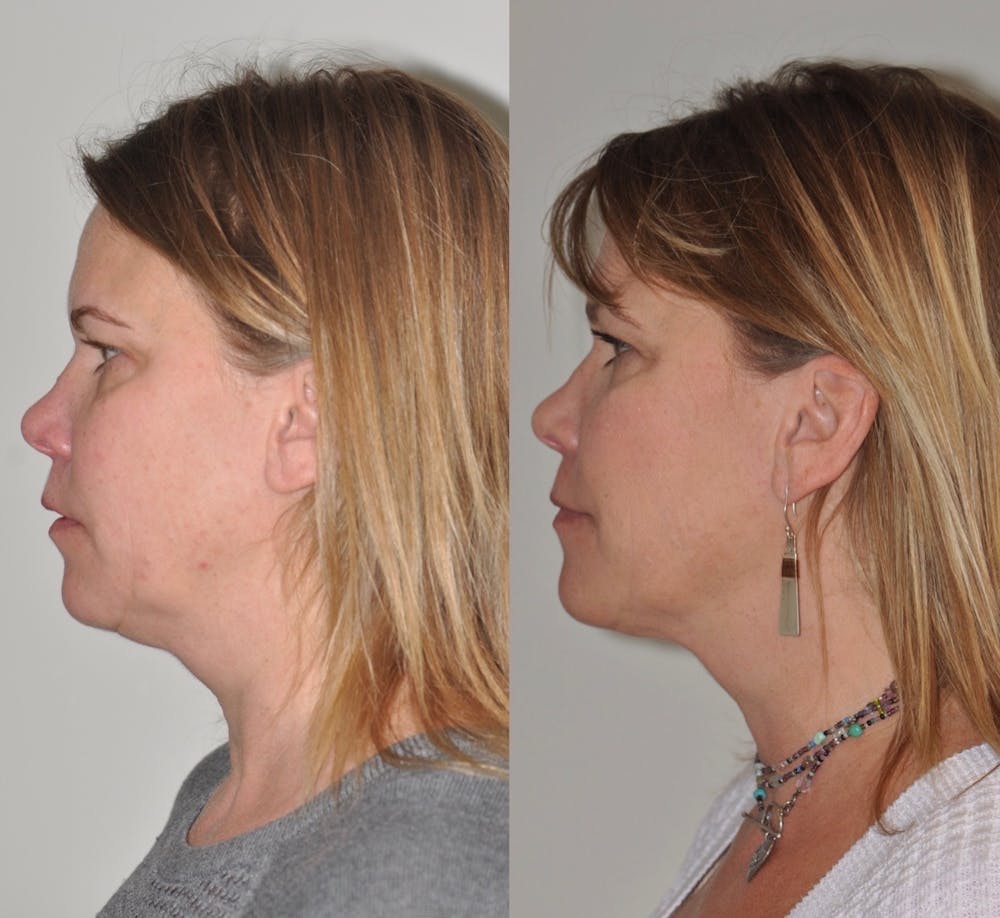 FaceTite & ThermiTight Before & After Gallery - Patient 31709213 - Image 3