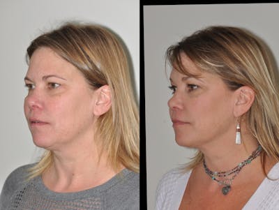 FaceTite & ThermiTight Before & After Gallery - Patient 31709213 - Image 4