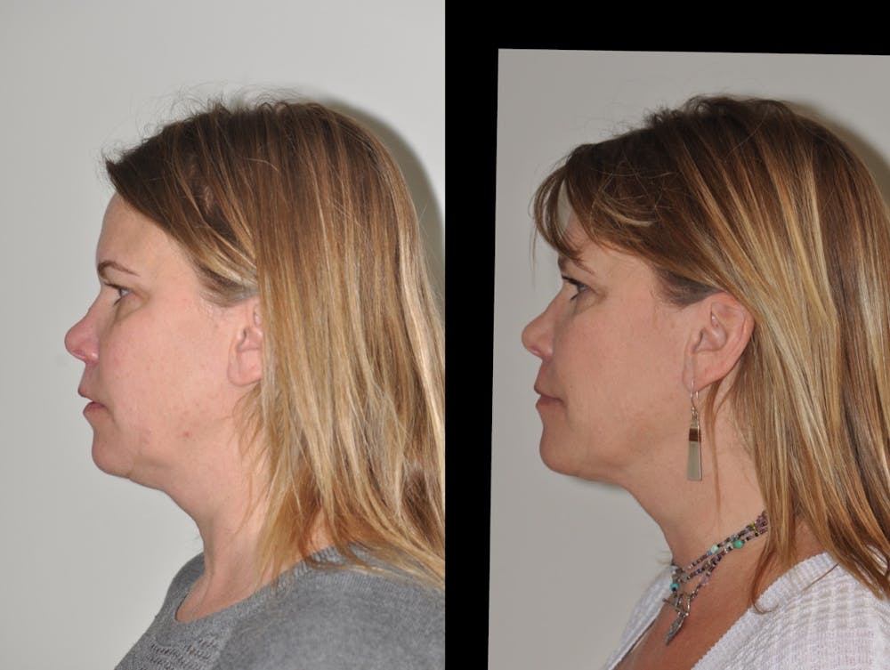 FaceTite & ThermiTight Before & After Gallery - Patient 31709213 - Image 5