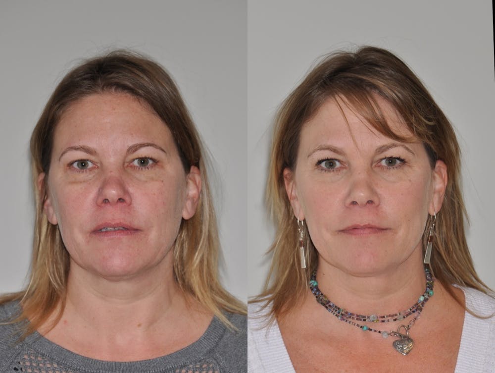 FaceTite & ThermiTight Before & After Gallery - Patient 31709213 - Image 6