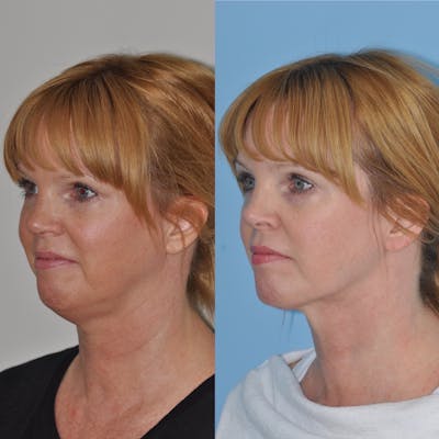 FaceTite & ThermiTight Before & After Gallery - Patient 31709215 - Image 1