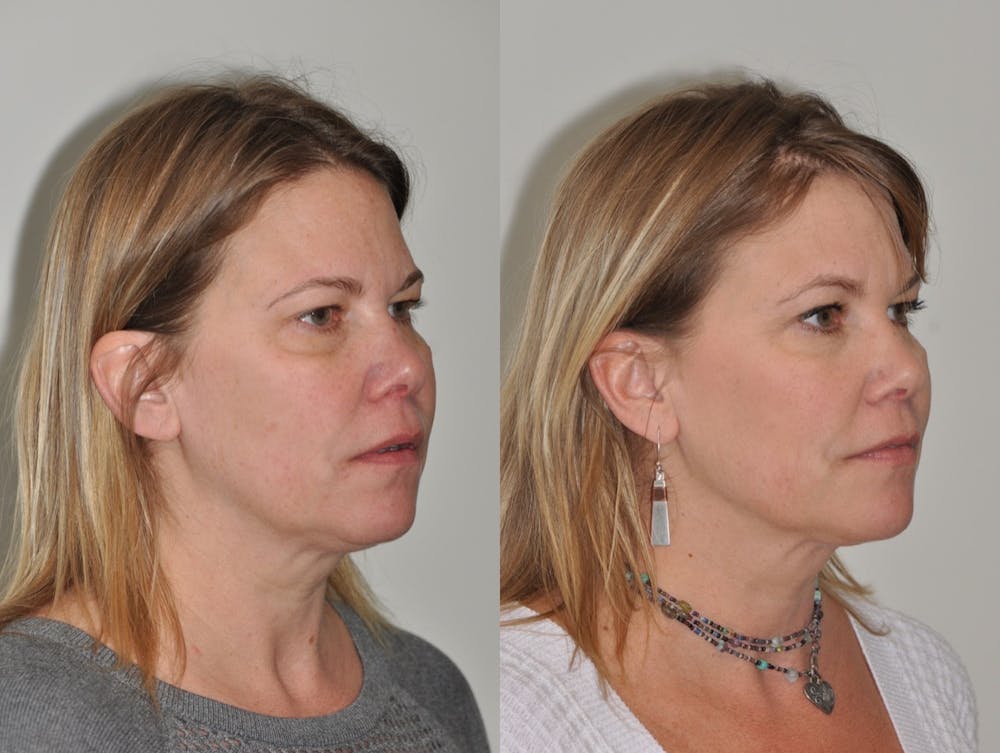 FaceTite & ThermiTight Before & After Gallery - Patient 31709213 - Image 7