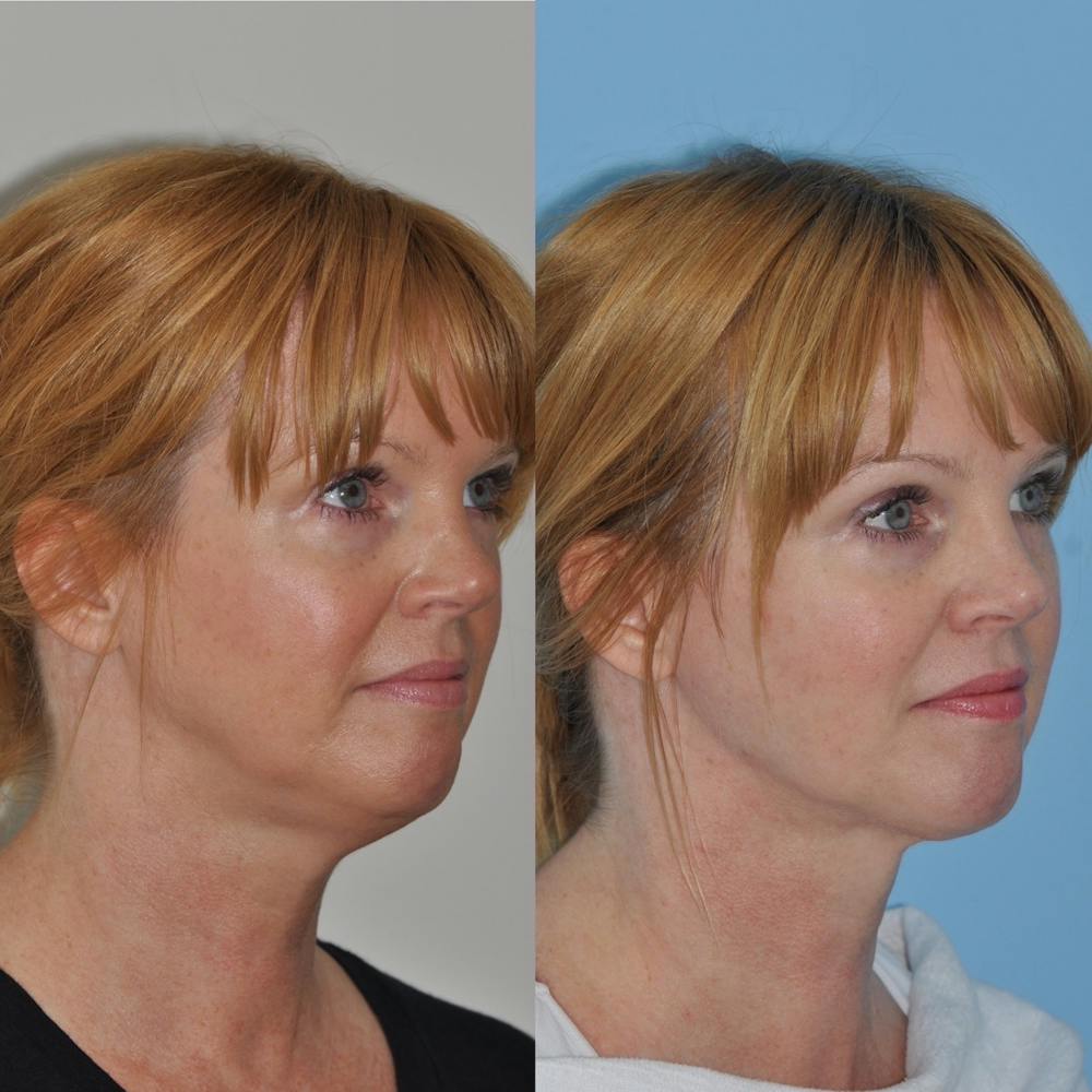 FaceTite & ThermiTight Before & After Gallery - Patient 31709215 - Image 2