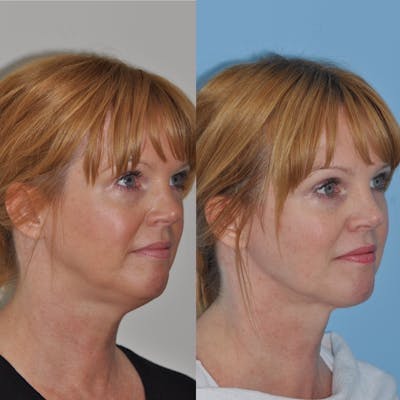FaceTite & ThermiTight Before & After Gallery - Patient 31709215 - Image 2