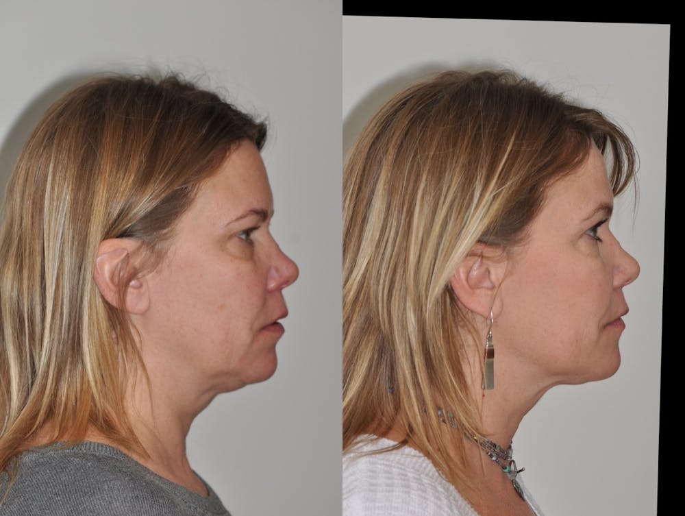 FaceTite & ThermiTight Before & After Gallery - Patient 31709213 - Image 8