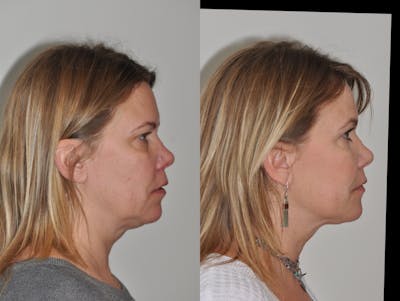 FaceTite & ThermiTight Before & After Gallery - Patient 31709213 - Image 8