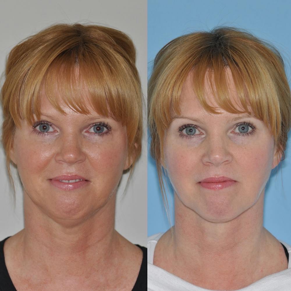FaceTite & ThermiTight Before & After Gallery - Patient 31709215 - Image 3
