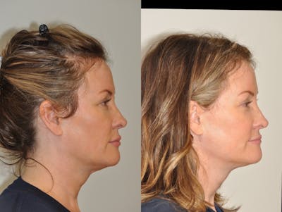 FaceTite & ThermiTight Before & After Gallery - Patient 31709216 - Image 1