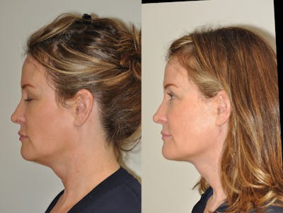FaceTite & ThermiTight Before & After Gallery - Patient 31709216 - Image 2