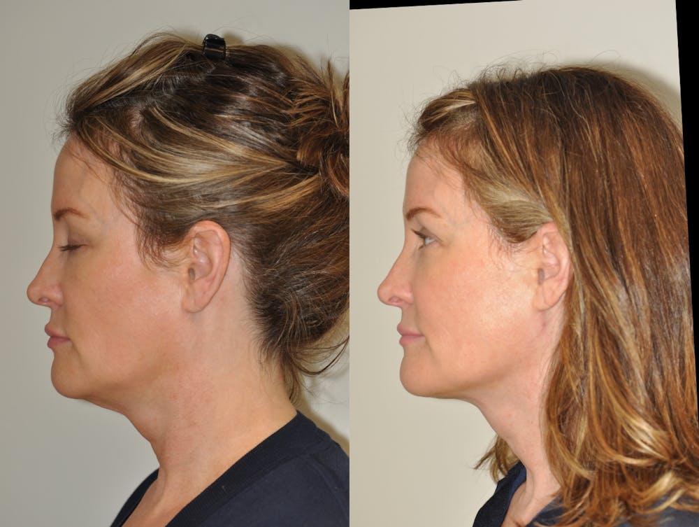FaceTite & ThermiTight Before & After Gallery - Patient 31709216 - Image 2