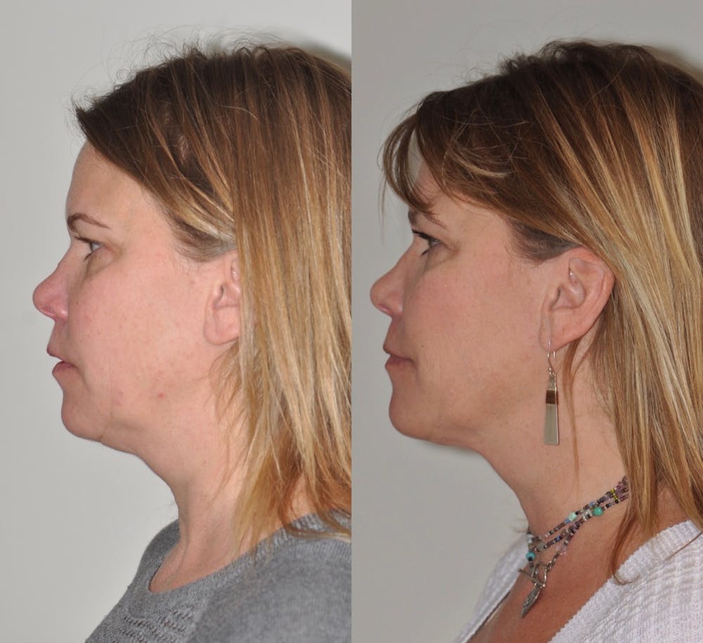 FaceTite & ThermiTight Before & After Gallery - Patient 31709213 - Image 9