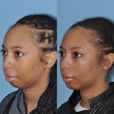 Buccal Fat Excision Before & After Gallery - Patient 31709226 - Image 1