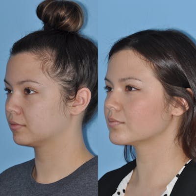 Buccal Fat Excision Before & After Gallery - Patient 31709227 - Image 1