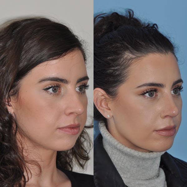 Buccal Fat Removal
