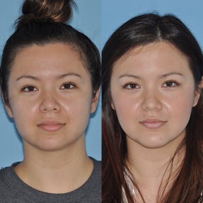 Buccal Fat Excision Before & After Gallery - Patient 31709227 - Image 2