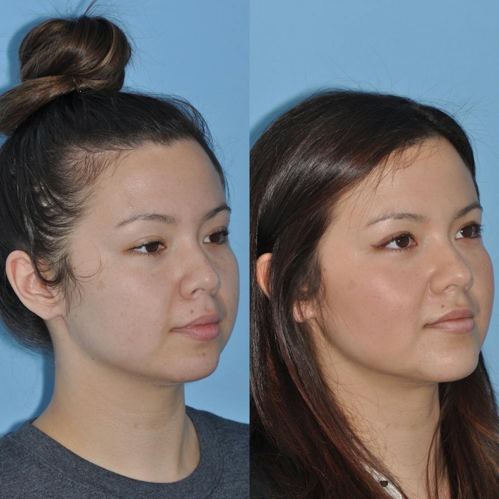 Buccal Fat Excision Before & After Gallery - Patient 31709227 - Image 3