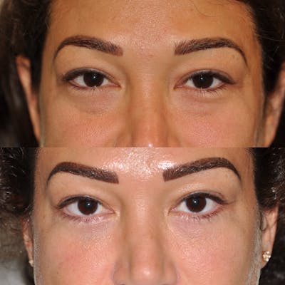 Blepharoplasty Before & After Gallery - Patient 31709251 - Image 1