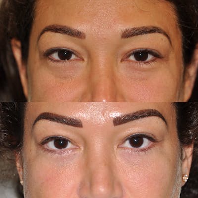 Blepharoplasty Before & After Gallery - Patient 31709251 - Image 1