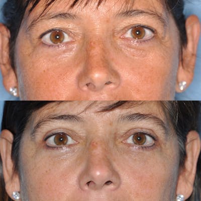 Blepharoplasty Before & After Gallery - Patient 31709252 - Image 1