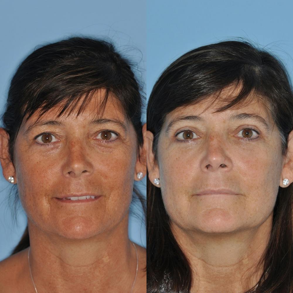 Blepharoplasty Before & After Gallery - Patient 31709252 - Image 2