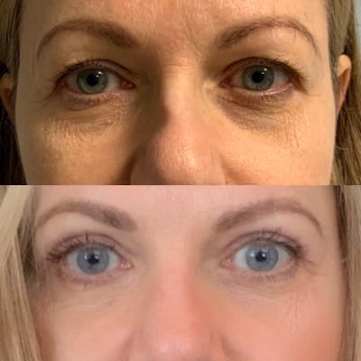 Blepharoplasty Before & After Gallery - Patient 31709253 - Image 1