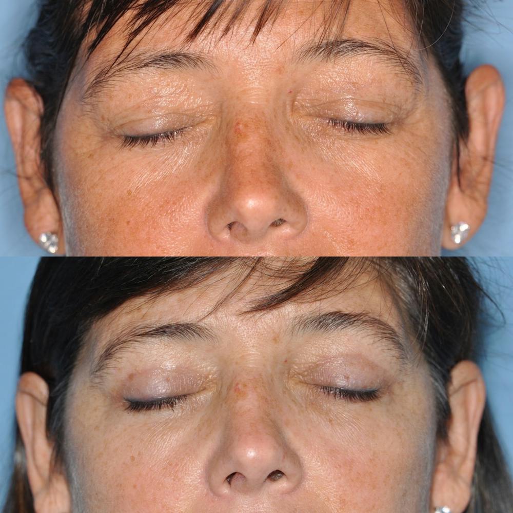 Blepharoplasty Before & After Gallery - Patient 31709252 - Image 3