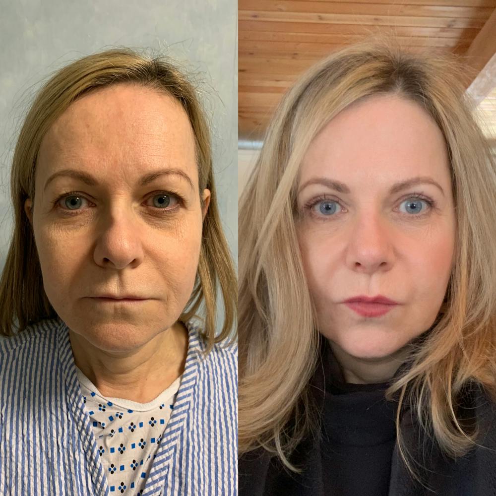 Blepharoplasty Before & After Gallery - Patient 31709253 - Image 2