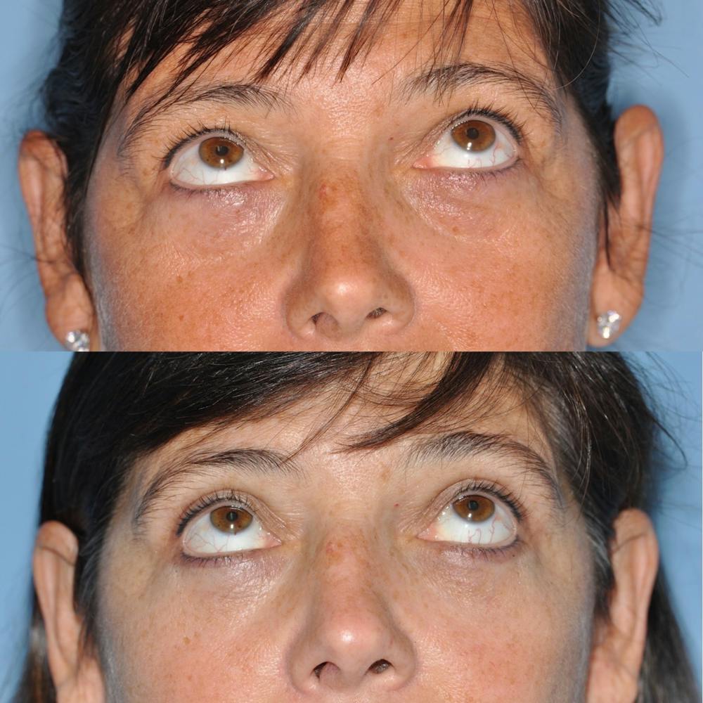 Blepharoplasty Before & After Gallery - Patient 31709252 - Image 4