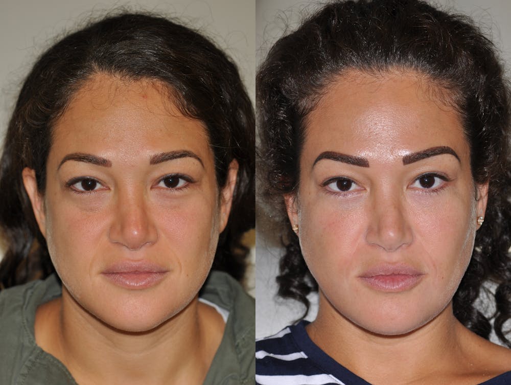 Blepharoplasty Before & After Gallery - Patient 31709251 - Image 3