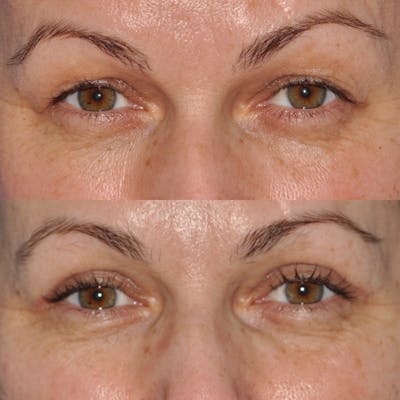 Blepharoplasty Before & After Gallery - Patient 31709256 - Image 1