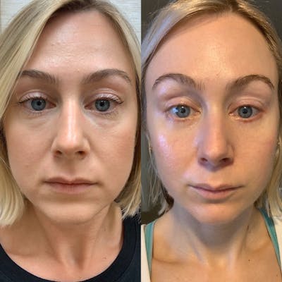 Blepharoplasty Before & After Gallery - Patient 31709254 - Image 2