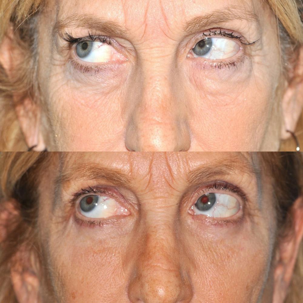 Blepharoplasty Before & After Gallery - Patient 31709255 - Image 2